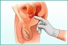 Palpácia prostaty