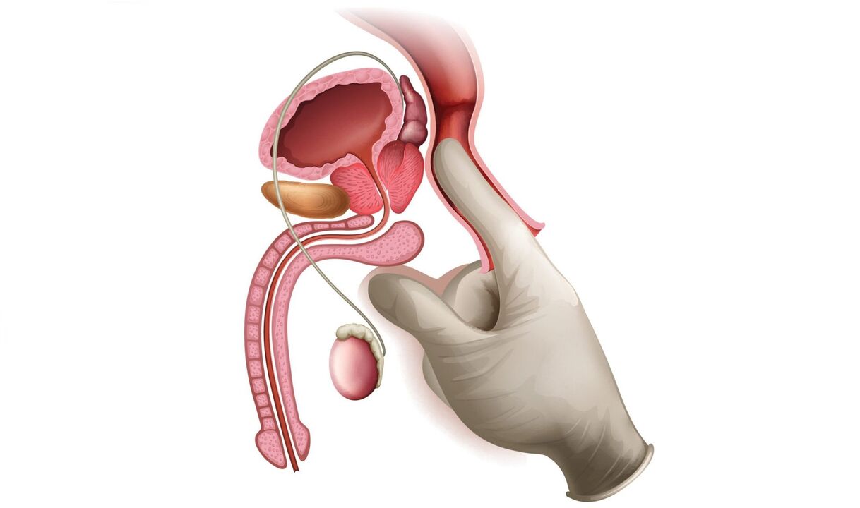masáž prostaty pri prostatitíde